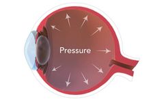 Solutions for Glaucoma and Intraocular Pressure (IOP)