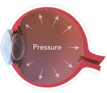 Solutions for Glaucoma and Intraocular Pressure (IOP) - Medical / Health Care