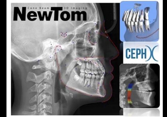 Newtom - CephX - Artificial Intellingence Cephalometry