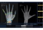 VUNO Med-BoneAge - X-ray Image Analysis Software