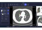Vuno Med - Version LungCT AI - Chest CT Data Analysis Software