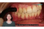 Management of Dentinal Hypersensitivity - Video