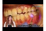 Gingival Contouring/Gingivoplasty Procedure using PIOON 450nm - Video