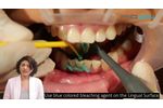 Dual In-office teeth whitening using S1 Pioon laser, 450nm wavelength - Video