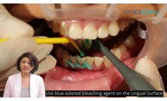 Dual In-office teeth whitening using S1 Pioon laser, 450nm wavelength - Video
