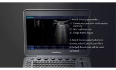 Lung Scan in SonoScape Ultrasound - Video