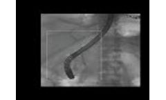 Using AI Image Guidance to reduce dose during interventional fluoroscopy procedures. - Video