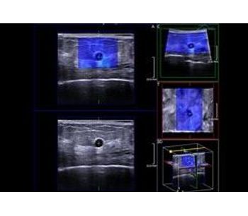 Ultrasound System for Breast Cancer Patients - Medical / Health Care - Clinical Services