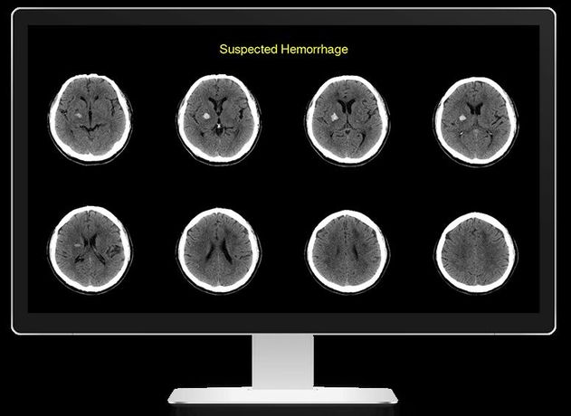 Rapid - Version ICH - Identifies Suspected Intracranial Hemorrhage Software