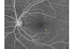 Therapy Solutions for Central Serous Chorioretinopathy - Medical / Health Care
