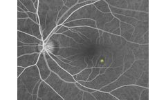 Therapy Solutions for Central Serous Chorioretinopathy
