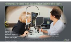 Laser retinopexy: Non-contact navigated laser treatment of a retinal tear with Navilas 577s - Video