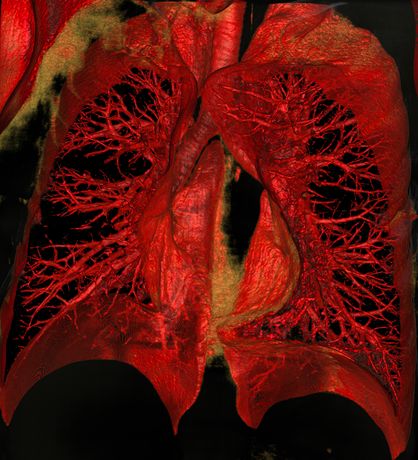 SeeFactor CT3 for Consider Lung Imaging - Medical / Health Care