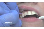 Desensitizing tooth surfaces using Brush&Bond or Pain-Free F. - Video