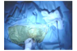 Minimally invasive microwave ablation in the liver - Video