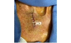 Surgical Skin Closure for Surgeons