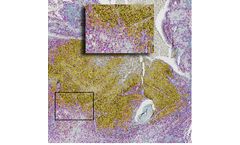 Immunoscore for  IC in Lung Cancer