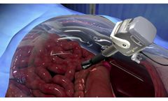 New View Surgical`s VisionPort System for Minimally Invasive Surgery - Video