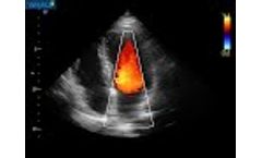 MR 4 Chamber - Lambda P9 Cardiovascular Ultrasound - Video