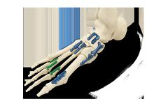 ARSENAL - Foot Plating System