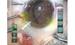 Cataract Surgery with MST Capsule Retractors - Video