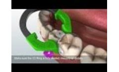 Using the Triodent V3 System - Video