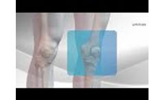 All-Inside ACL Reconstruction with Arthrex GraftLink - Video