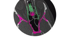 Brainlab - Electromagnetic ENT Navigation