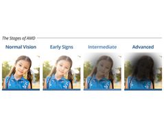 Figure 3: Visual Effect of Age-related Macular Degeneration (AMD).