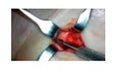 Example of SurgiCam HD Footage (Hand Surgery) - Video