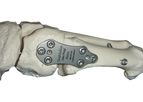 Osteo-WEDGE - Open Wedge Bone Locking System