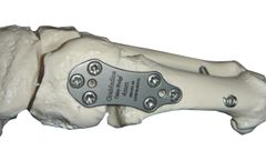 Osteo-WEDGE - Open Wedge Bone Locking System