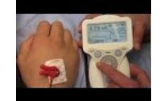 Stimpod Nerve Locating Technique - Video