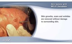 Removal of Skin Lesions with the MCL31 Dermablate Erbium Laser by Asclepion - Video