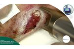 Wound Healing Cases Collection - Case 01 Surgical Dehiscence - Video