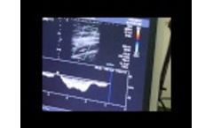 Femoral Vein Flow Using Duplex Ultrasound & Hands-Free Augmentation Device - Video