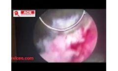 ACE Bipolar Cutting Loop Electrode - Video