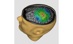 NBT - Navigated Brain Therapy System for Alleviating Chronic Neuropathic Pain Relief