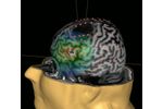 Transcranial Magnetic Stimulation (TMS) for Neurosurgery - Medical / Health Care - Clinical Services