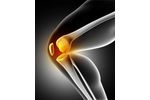 Knee Osteoarthritis - Medical / Health Care - Clinical Services
