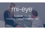 mi eye 2 | In-Office Knee Arthroscopy - Dr. John Xerogeanes - Video