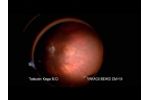 TAKAGI OM-19 Operating Microscope, Retinal Examination - Video
