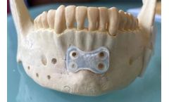 Bionacre - Naturally-Resorbable Dental Device