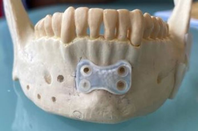 Bionacre - Naturally-Resorbable Dental Device
