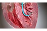 Helix Transendocardial Delivery System - Video