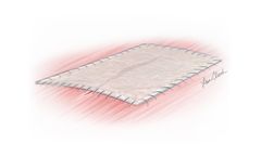 Biodesign - 4-Layer Tissue Graft