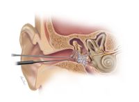 Canwell - Trauma Series - 3.5Mm Distal Medial Tibial Locking