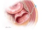 Biodesign - Enterocutaneous Fistula Plug