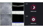 SPECTRALIS OCT1 vs. OCT2: Retina Dense Posterior Pole Scan - Video