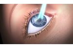 Features of SCHWIND AMARIS Excimer Laser for refractive surgery laser treatments - Video